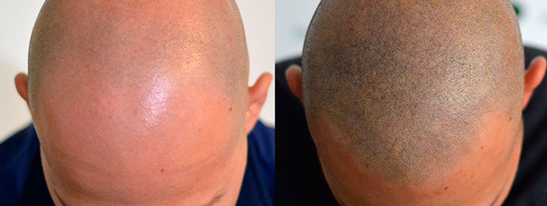 micropigmentation
